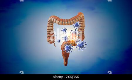 Concetto medico di infezione intestinale crasso Foto Stock