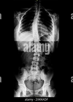 Radiografia della scoliosi idiopatica a forma Di S della colonna toracica e lombare. Parte dello scheletro con curvatura spinale su sfondo nero. Deformazione della dorsale laterale. Immagine radiologica della schiena e del bacino. Foto Stock