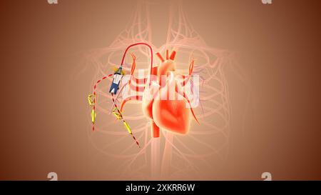 Una porta per chemioterapia viene inserita all'interno del corpo con un catetere per trasfusioni di sangue Foto Stock