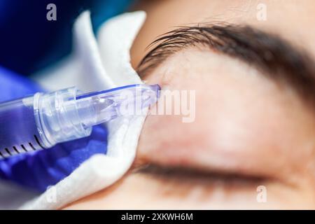 Paziente che riceve una procedura di idratazione mesoterapia sulle palpebre con microneedle presso l'ufficio dermatologo. Foto Stock