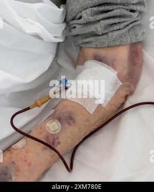 Persona anziana non identificata che riceve siero trasfusionale di sangue dal braccio nella stanza dell'ospedale. Concetto medico. Foto Stock