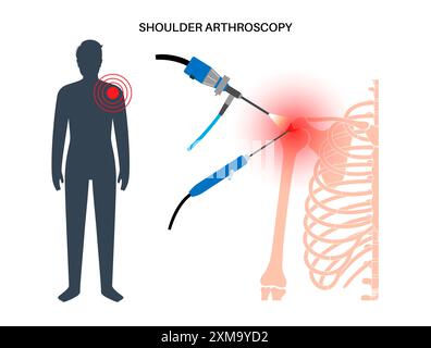 Illustrazione di una procedura di artroscopia della spalla. Si tratta di una procedura per la diagnosi e il trattamento dei problemi articolari. Un chirurgo inserisce un tubo stretto collegato a una videocamera a fibra ottica attraverso una piccola incisione. Foto Stock