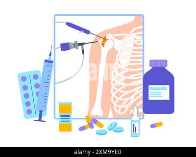 Illustrazione di una procedura di artroscopia della spalla. Si tratta di una procedura per la diagnosi e il trattamento dei problemi articolari. Un chirurgo inserisce un tubo stretto collegato a una videocamera a fibra ottica attraverso una piccola incisione. Foto Stock