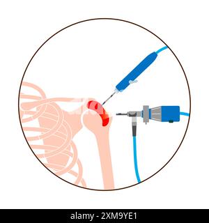 Illustrazione di una procedura di artroscopia della spalla. Si tratta di una procedura per la diagnosi e il trattamento dei problemi articolari. Un chirurgo inserisce un tubo stretto collegato a una videocamera a fibra ottica attraverso una piccola incisione. Foto Stock