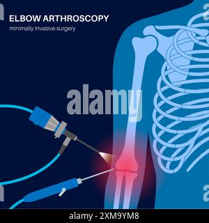 Illustrazione di un intervento chirurgico di artroscopia del gomito. Si tratta di una procedura per la diagnosi e il trattamento dei problemi articolari. Un chirurgo inserisce un tubo stretto collegato a una videocamera a fibra ottica attraverso una piccola incisione. Foto Stock