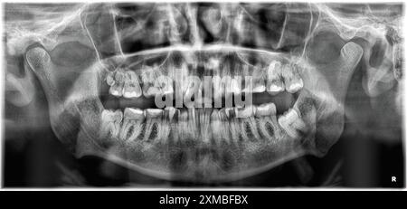 Immagine radiografica panoramica dentale - i maschi di 35 anni hanno il quarto molare sul lato sinistro - la maggior parte dei dentini è con otturazioni Foto Stock