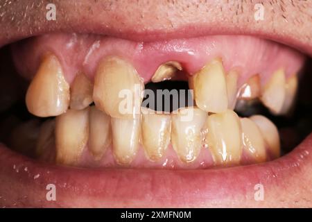 Denti storti in bocca. Ortodonzia. Malocclusione. Malattia dentale, denti non kempt. Problemi dentali. Foto Stock