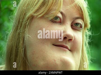 Una giovane donna con il cherubismo. La rara condizione genetica è una forma ereditaria di displasia poliostotica fibroQuesta è Vicky Lucas di Durrington, vicino a Worthing, Sussex, che ha preso parte a un documentario della BBC sulla vita con la deformità facciale, The Human Face. Era una studentessa di 21 anni che aveva rifiutato l'intervento chirurgico. Displasia fibrosa è una malattia ossea caratterizzata da aree di crescita anomala o lesioni in una, più o molte ossa. Il cranio è spesso colpito 22 giugno 2000 Foto Stock