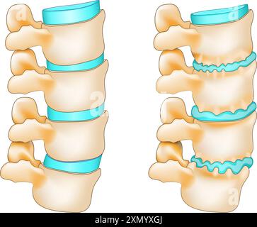 Disco degenerativo con formazione di osteofiti e colonna vertebrale normale. Invecchiamento della colonna vertebrale con speroni ossei e ernia del disco. Osteoartrite spinale. Illustrazione vettoriale Illustrazione Vettoriale