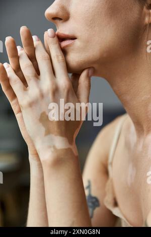 Una giovane donna con vitiligine riposa il mento nelle sue mani, perduta nel pensiero nella sua comoda camera da letto. Foto Stock