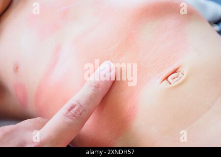 Mano del medico applicando crema medica antistaminica topica sul corpo della bambina con grave eruzione cutanea e allergia Foto Stock