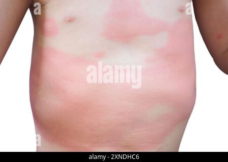 Eczema grave eruzione cutanea e reazione allergica simtom a Little asian Child body causa da ipersensibilità isolato su sfondo bianco Foto Stock