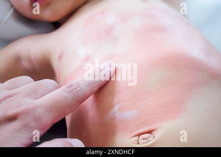 Mano del medico applicando crema medica antistaminica topica sul corpo della bambina con grave eruzione cutanea e allergia Foto Stock