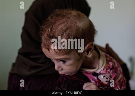 25 luglio 2024, Siria, Atimah: Il bambino Marwan Shahen, 7 mesi, soffre di grave malnutrizione. I residenti dei campi nel nord-ovest della Siria devono affrontare condizioni umanitarie disastrose a causa della mancanza di finanziamenti, che ha portato alla cessazione delle distribuzioni di panieri alimentari e a un aumento dei casi di malnutrizione nel 2024. Secondo un rapporto OCHA, il 50% delle strutture sanitarie cesserà le operazioni parzialmente o completamente entro dicembre, con 3,6 milioni di persone che soffrono di insicurezza alimentare. Foto: Anas Alkharboutli/dpa Foto Stock