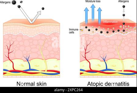 Dermatite atopica. Eczema. Sezione trasversale della pelle normale e infiammazione della pelle secca. Illustrazione vettoriale Illustrazione Vettoriale