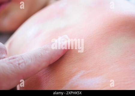 Mano del medico applicando crema medica antistaminica topica sul corpo della bambina con grave eruzione cutanea e allergia Foto Stock