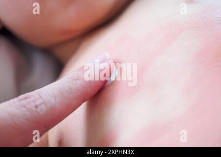 Mano del medico applicando crema medica antistaminica topica sul corpo della bambina con grave eruzione cutanea e allergia Foto Stock