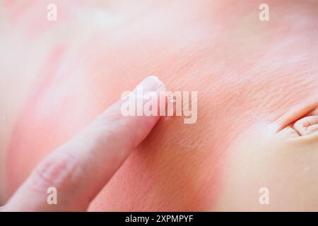 Mano del medico applicando crema medica antistaminica topica sul corpo della bambina con grave eruzione cutanea e allergia Foto Stock