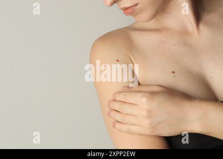 Donna con talpe sulla pelle su sfondo grigio chiaro, primo piano. Spazio per il testo Foto Stock