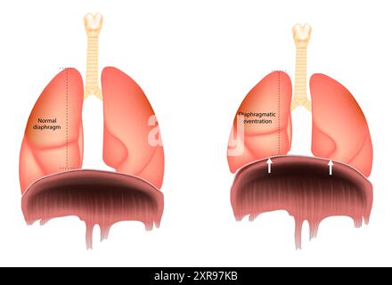 Normale eventrazione diaframma o diaframma. Elevazione anomala di una porzione o dell'intero emidiaframma. Illustrazione Vettoriale