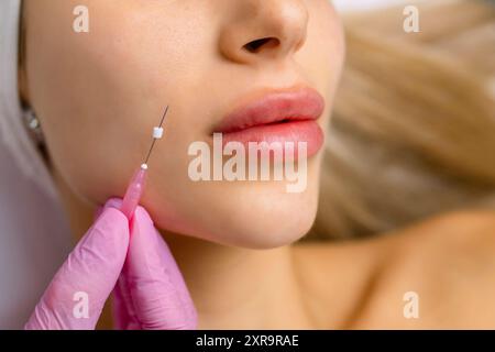 Face Lifting PDO suture Operation. Tecnica innovativa di New thread lift, cosmetologist preparandosi a fare la procedura per il cliente femminile, selezionare il Foto Stock