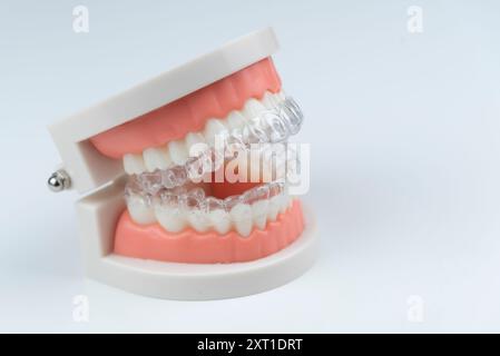 Cure dentistiche. Gli allineatori sono collocati su un modello artificiale di una mascella umana. Foto Stock