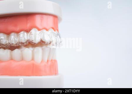 Cure dentistiche. Gli allineatori sono collocati su un modello artificiale di una mascella umana. Foto Stock