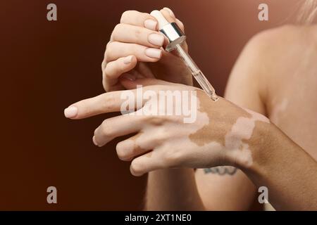 Una giovane donna con vitiligine applica un prodotto per la cura della pelle alla sua mano. Foto Stock