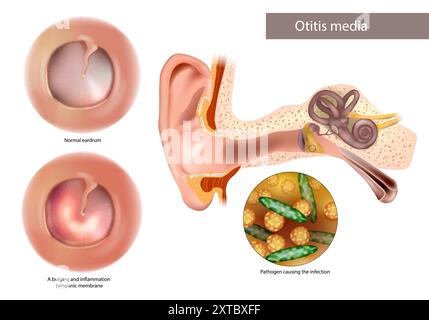 Otite media o suppurativa cronica. Patogeno che causa l'infezione. Membrana timpanica normale, rigonfiamento e infiammazione. Illustrazione Vettoriale