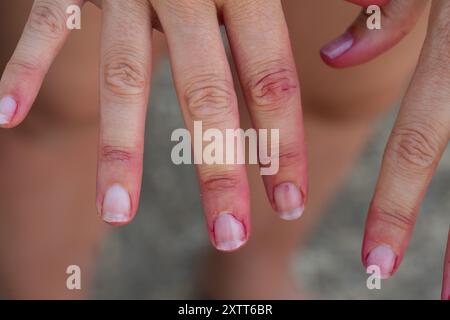 Donna che mostra le unghie danneggiate dopo una sessione di manicure Foto Stock