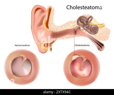 Colesteatoma e Eardrum normale. Timpano ritratto e perforato. Otorinolaringoiatria Illustrazione Vettoriale