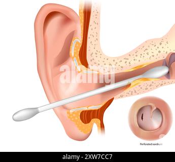 I tamponi di cotone sono una delle principali cause di perforazione del timpano. Rischi di utilizzo di tamponi di cotone per la pulizia delle orecchie. Illustrazione Vettoriale