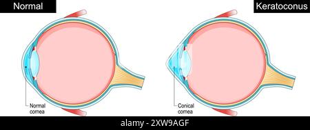 Cheratocono. Disturbo dell'occhio. Diradamento della cornea. Malattia progressiva dell'occhio. Astigmatismo. Cornea irregolare. Diagramma schematico. Illustrazione vettoriale dettagliata Illustrazione Vettoriale