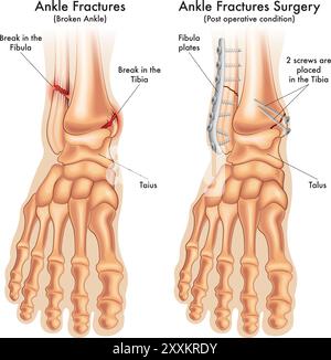l'illustrazione medica confronta una caviglia fratturata prima e dopo l'intervento chirurgico, con le annotazioni. Illustrazione Vettoriale