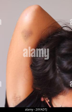 Un livido a forma di cuore sul braccio di una giovane donna simboleggia il dolore e l'impatto delle relazioni tossiche e della violenza di genere. Foto Stock