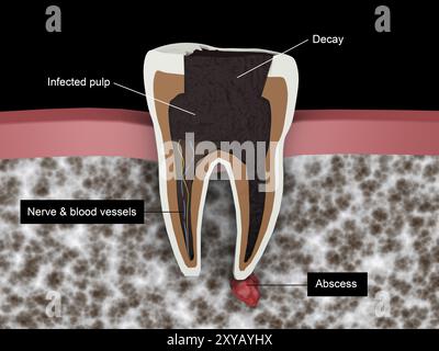 Vista in sezione della cavità di un dente Foto Stock