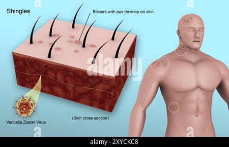 Diagramma medico che mostra l'herpes zoster causato dal virus varicella-zoster Foto Stock