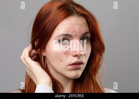 Ritratto di una giovane donna caucasica con i capelli rossi, toccando i capelli e mostrando la sua pelle problematica su uno sfondo grigio Foto Stock