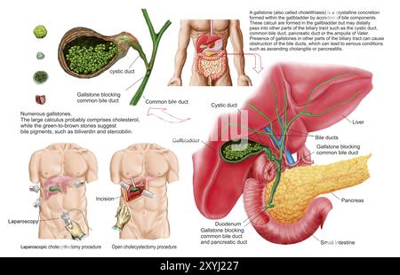 Ilustration medico che mostra calcoli biliari nella colecisti e la rimozione chirurgica della colecisti, nota come colecistectomia Foto Stock