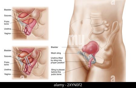 Anatomia della procedura di sospensione vescicale per incontinenza urinaria nelle donne Foto Stock