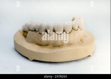 Ganascia superiore modello finito con corone in ceramica Foto Stock