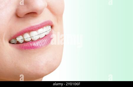 Primo piano di una bocca con rinforzi su denti e la lingua fuori, isolato in verde Foto Stock