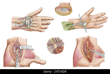 Illustrazione medica che mostra la sindrome del tunnel carpale nel polso umano e le procedure chirurgiche ad esso associate Foto Stock