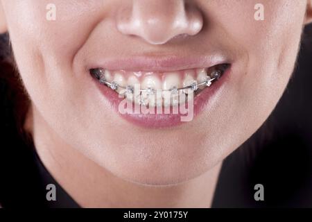 Denti con bretelle, primo piano. foto di una giovane donna Foto Stock