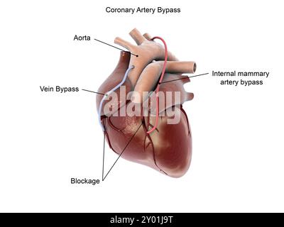 Bypass coronarico del cuore umano Foto Stock