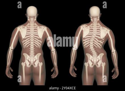 Confronto tra una colonna vertebrale umana normale e una colonna vertebrale con scoliosi Foto Stock