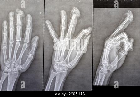 I raggi X semplici rivelano l'amputazione distale della falange distale del dito medio della mano sinistra di un uomo adulto, causata da una macchina a lama affilata e Foto Stock
