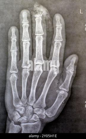 I raggi X semplici rivelano l'amputazione distale della falange distale del dito medio della mano sinistra di un uomo adulto, causata da una macchina a lama affilata e Foto Stock