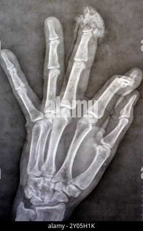 I raggi X semplici rivelano l'amputazione distale della falange distale del dito medio della mano sinistra di un uomo adulto, causata da una macchina a lama affilata e Foto Stock