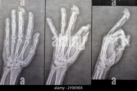 I raggi X semplici rivelano l'amputazione distale della falange distale del dito medio della mano sinistra di un uomo adulto, causata da una macchina a lama affilata e Foto Stock